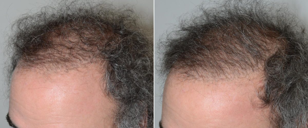 Body Hair Transplant Before and after in Miami, FL, Paciente 59102