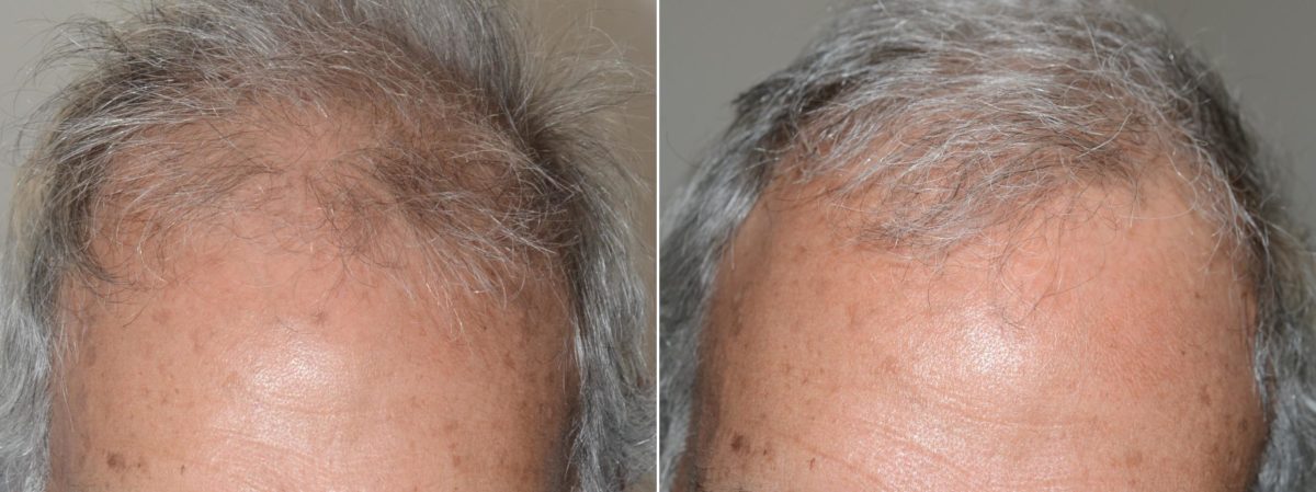 Body Hair Transplant Before and after in Miami, FL, Paciente 59197