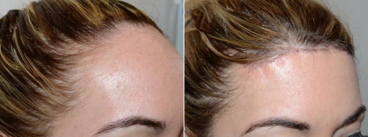Hairline Advancement Before and after in Miami, FL, Paciente 58861
