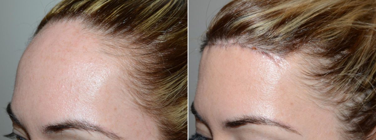 Forehead Reduction Surgery Before and after in Miami, FL, Paciente 58861