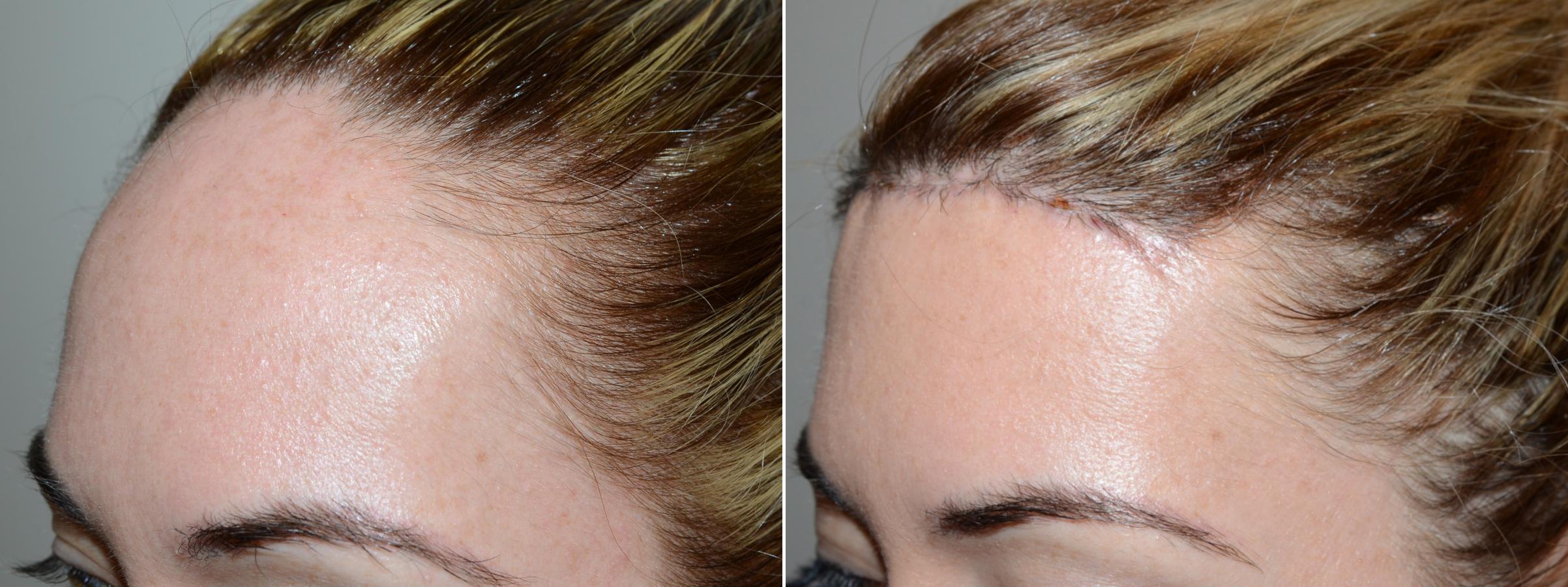 Forehead Reduction Surgery photos | Miami, FL | Patient58861
