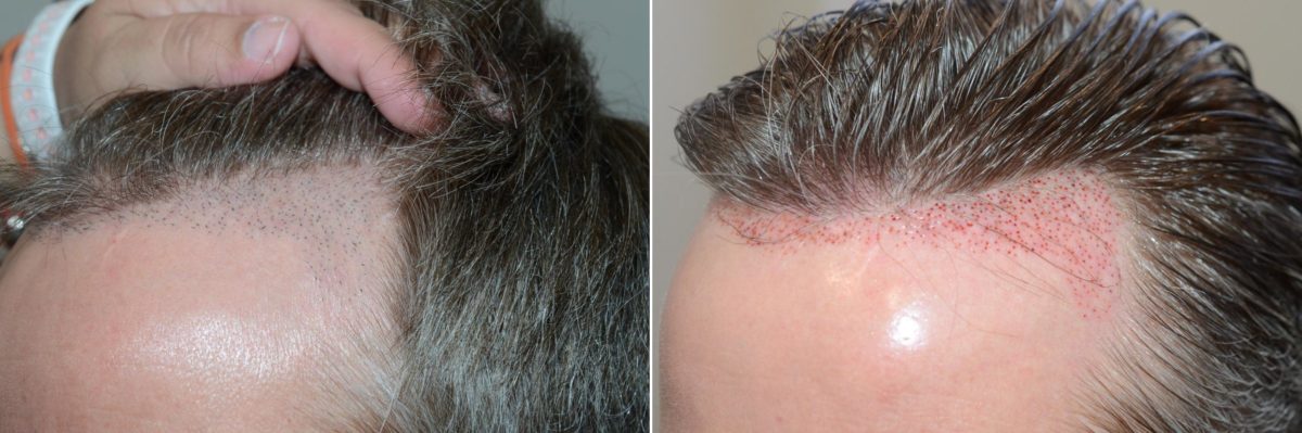 Reparative Hair Transplant Before and after in Miami, FL, Paciente 59187