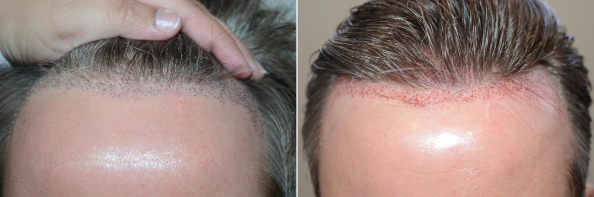 Reparative Hair Transplant Before and after in Miami, FL, Paciente 59187