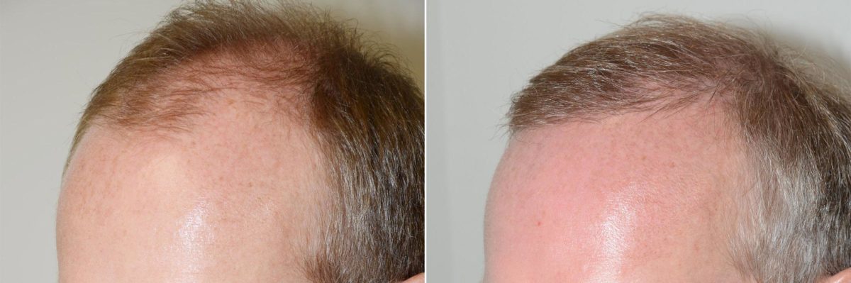 Hair Transplants for Men Before and after in Miami, FL, Paciente 59541