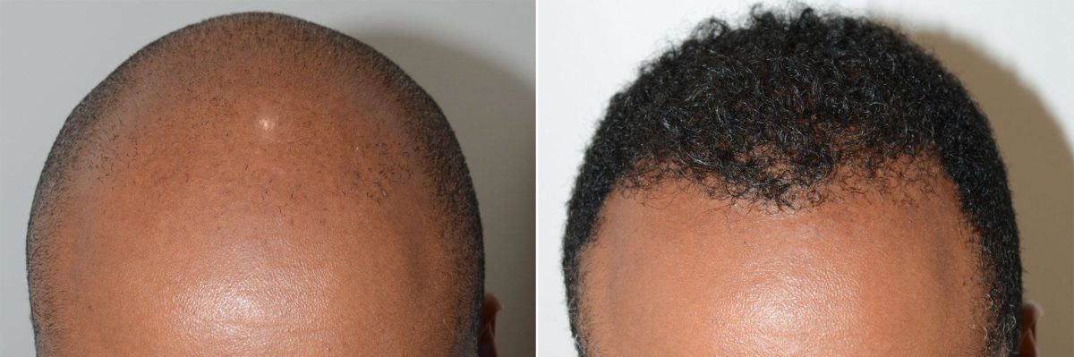 Hair Transplants for Men Before and after in Miami, FL, Paciente 59551