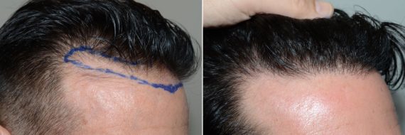 Hair Transplants for Men Before and after in Miami, FL, Paciente 59572