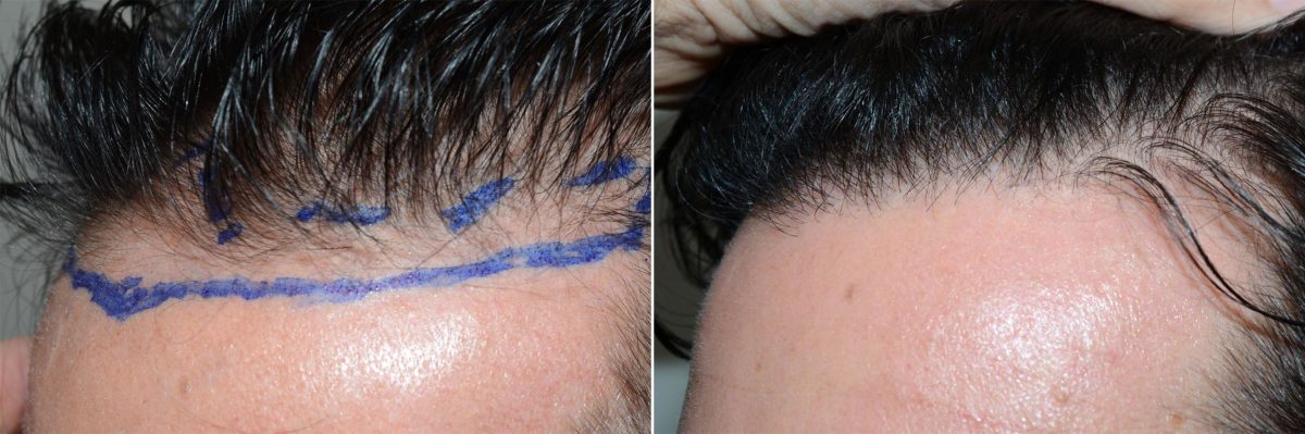 Hair Transplants for Men Before and after in Miami, FL, Paciente 59572