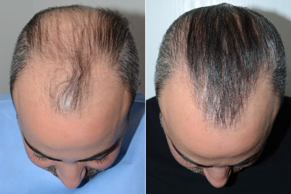 Hair Transplants for Men Before and after in Miami, FL, Paciente 59522