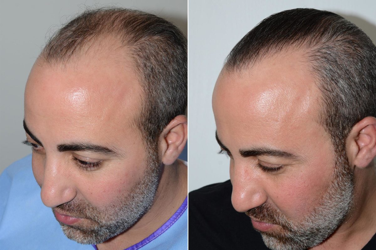 Hair Transplants for Men Before and after in Miami, FL, Paciente 59522