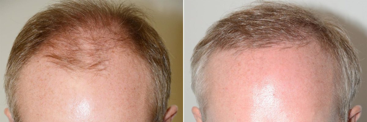 Hair Transplants for Men Before and after in Miami, FL, Paciente 59541