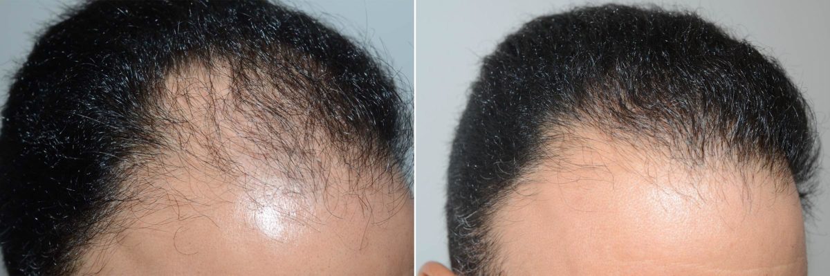 Hair Transplants for Men Before and after in Miami, FL, Paciente 59605