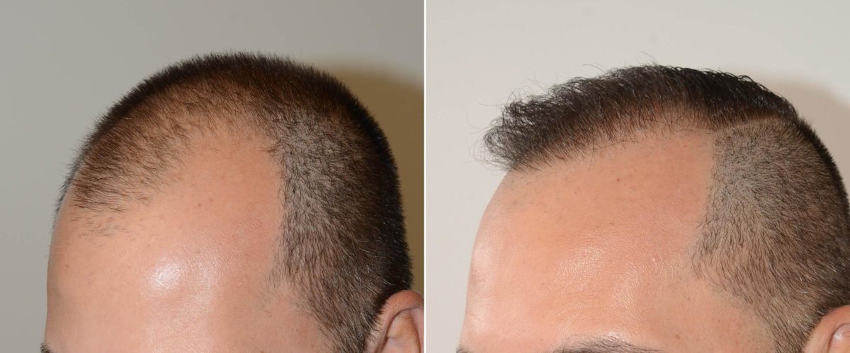 Hair Transplants for Men Before and after in Miami, FL, Paciente 59634