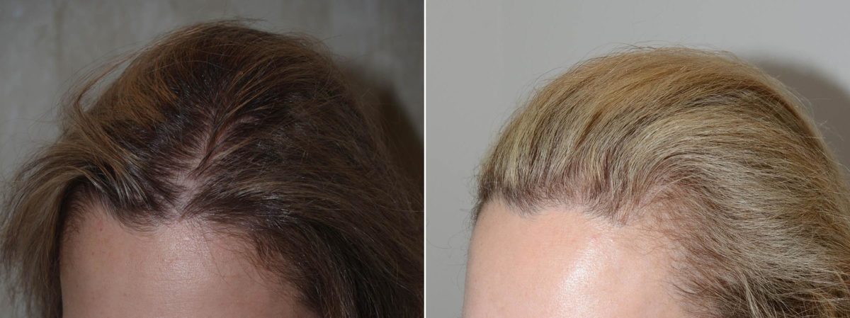 Hair Transplants for Women Before and after in Miami, FL, Paciente 59657