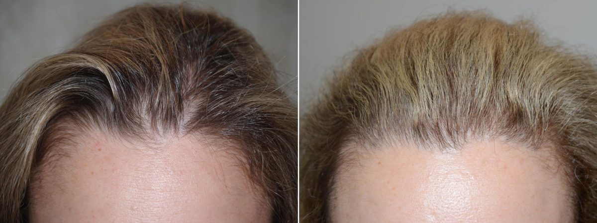 Hair Transplants for Women Before and after in Miami, FL, Paciente 59657