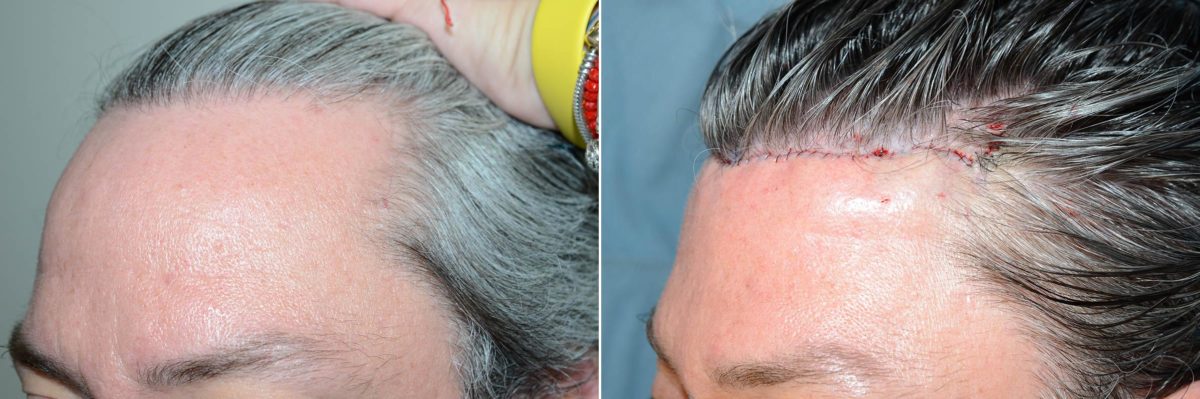 Hairline Advancement Before and after in Miami, FL, Paciente 59665