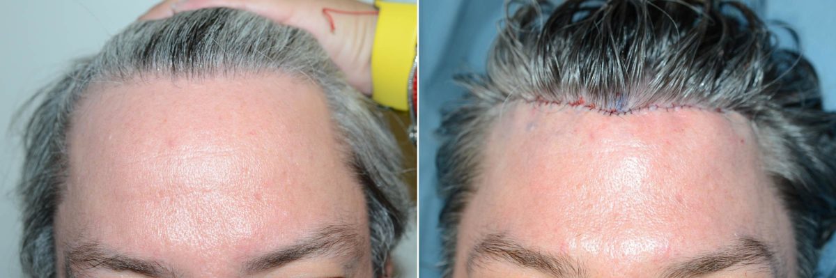 Forehead Reduction Surgery Before and after in Miami, FL, Paciente 59665