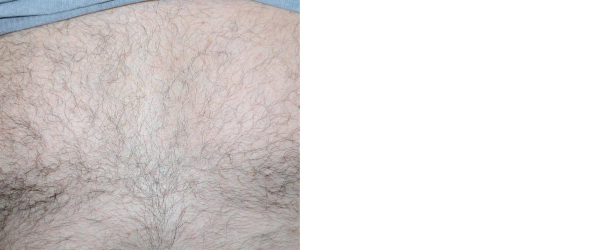 Body Hair Transplant Before and after in Miami, FL, Paciente 59102