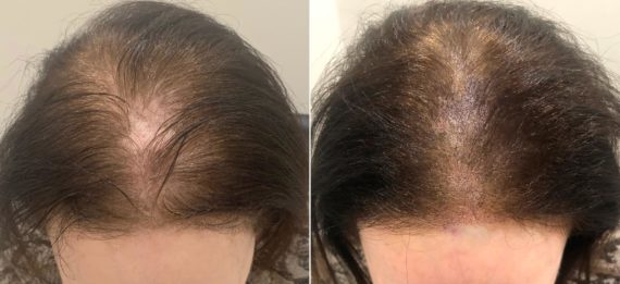 Scalp Micropigmentation Before and after in Miami, FL, Paciente 59751