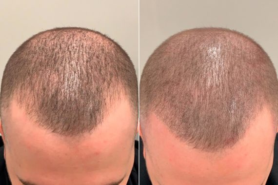 Scalp Micropigmentation Before and after in Miami, FL, Paciente 59740