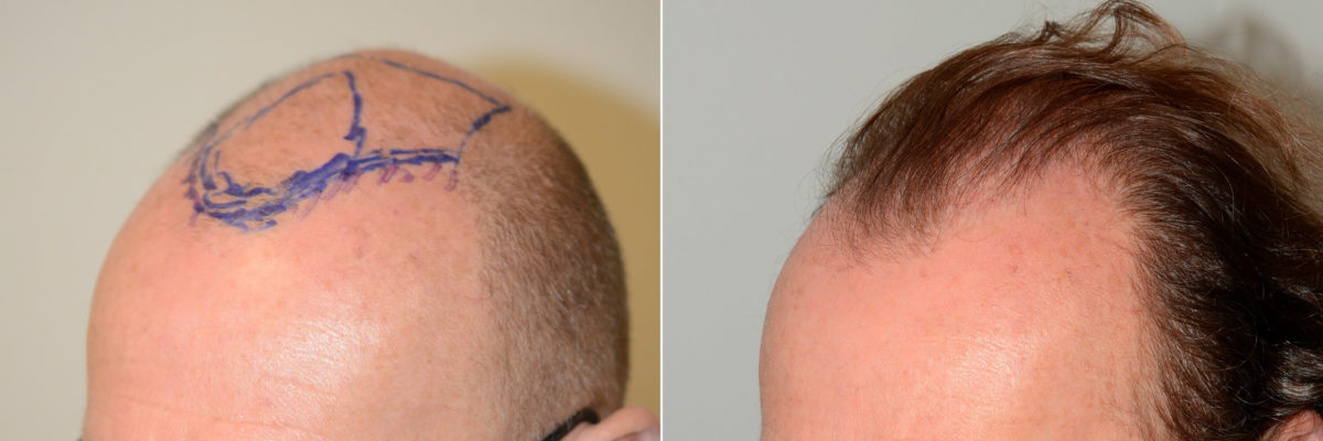 Hair Transplants for Men Before and after in Miami, FL, Paciente 60031