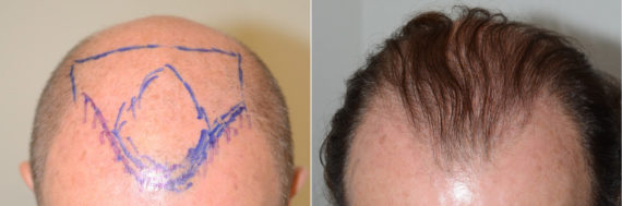 Trasplante de Pelo en Hombres Before and after in Miami, FL, Paciente 60487