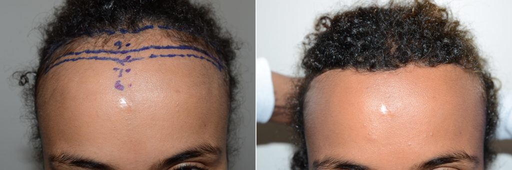 Mujer africana de 20 años de edad fue capaz de lograr más de una pulgada de bajada de la línea del cabello en una sola etapa de la cirugía de reducción de la frente.