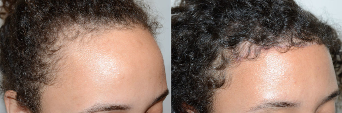 Hairline Advancement Before and after in Miami, FL, Paciente 60137