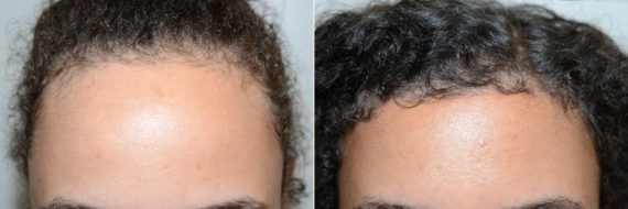 Hairline Advancement Before and after in Miami, FL, Paciente 60137