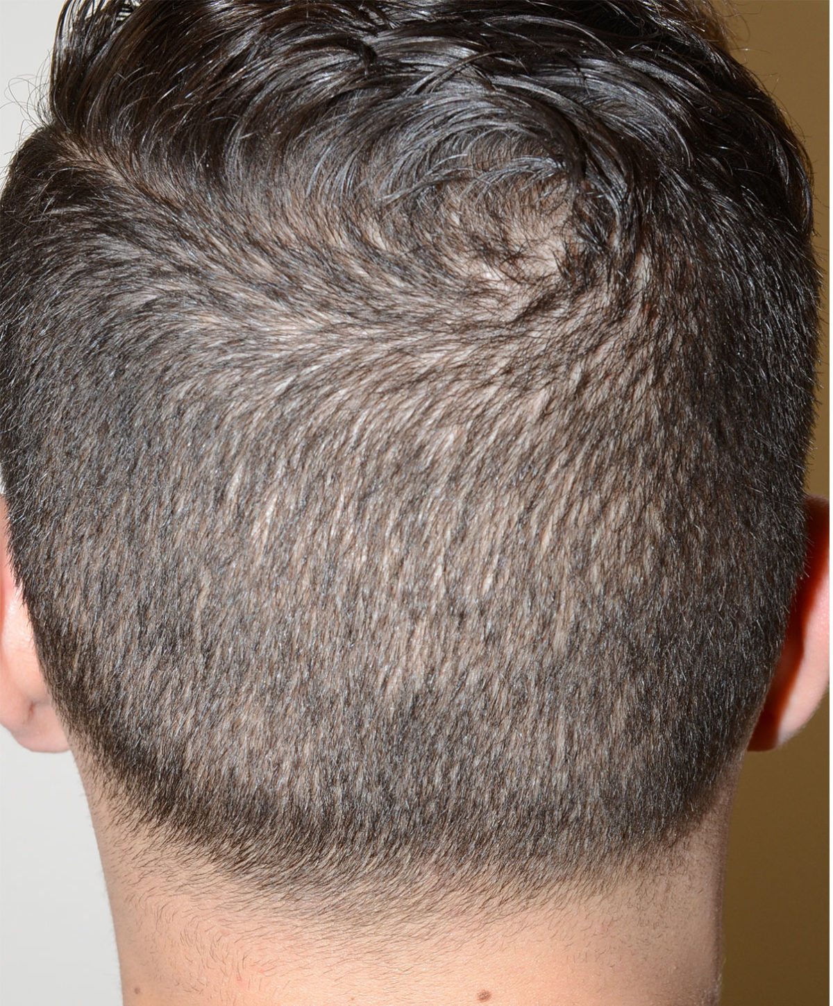 Hair Transplants for Men Before and after in Miami, FL, Paciente 47557