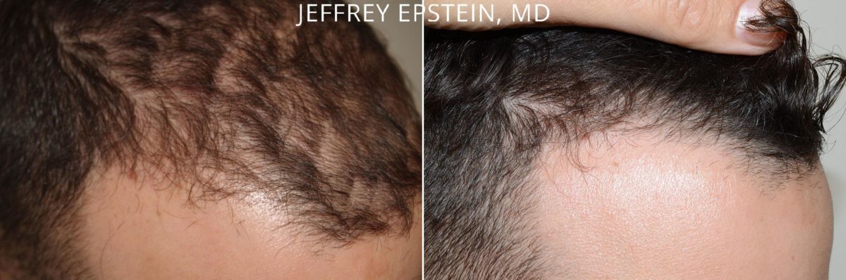 Hair Transplants for Men Before and after in Miami, FL, Paciente 47557