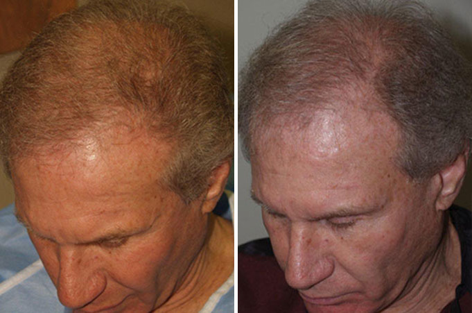 Trasplante de Pelo en Hombres Before and after in Miami, FL, Paciente 37887