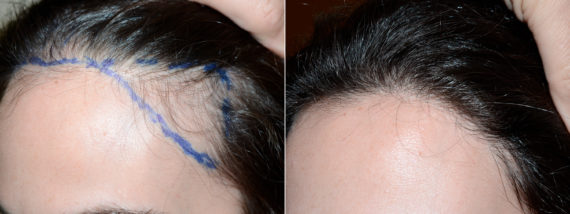 Hair Transplants for Women Before and after in Miami, FL, Paciente 71499