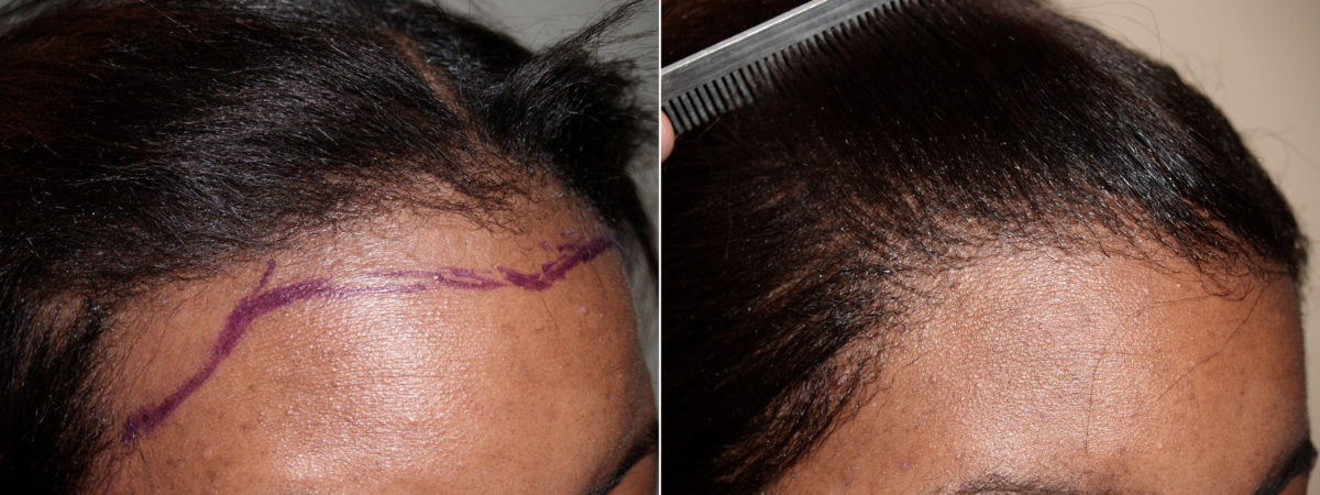 Hair Transplants for Women Before and after in Miami, FL, Paciente 71518