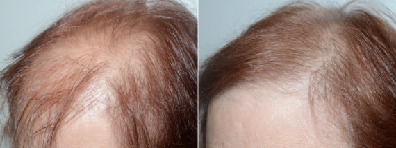 Hair Transplants for Women Before and after in Miami, FL, Paciente 74079
