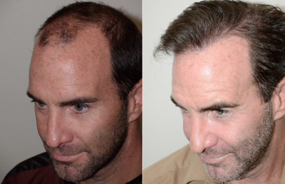 Trasplante masculino Before and after in Miami, FL, Paciente 99685