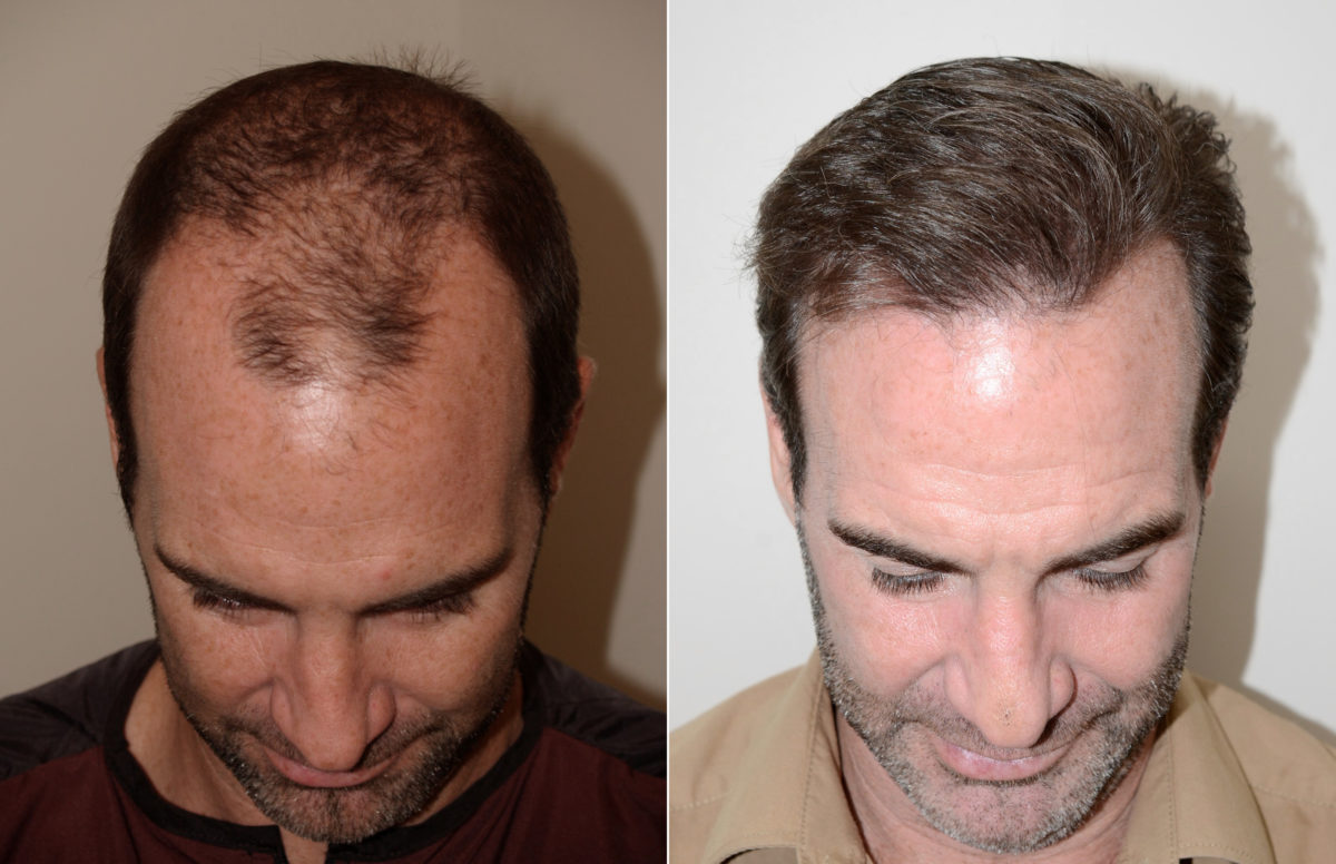 Male Hair Transplant Before and after in Miami, FL, Paciente 74093