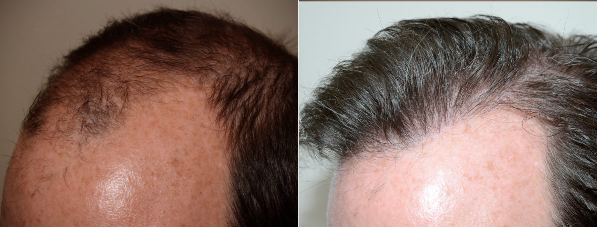 Male Hair Transplant Before and after in Miami, FL, Paciente 74093