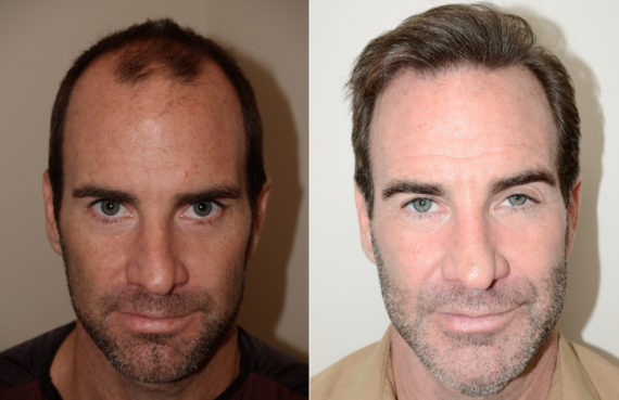 Male Transplant Before and after in Miami, FL, Paciente 74093