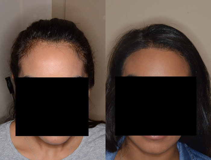 Before and After 1700 Grafts