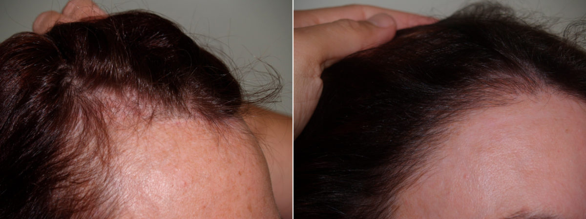 Hair Transplants for Women Before and after in Miami, FL, Paciente 70923