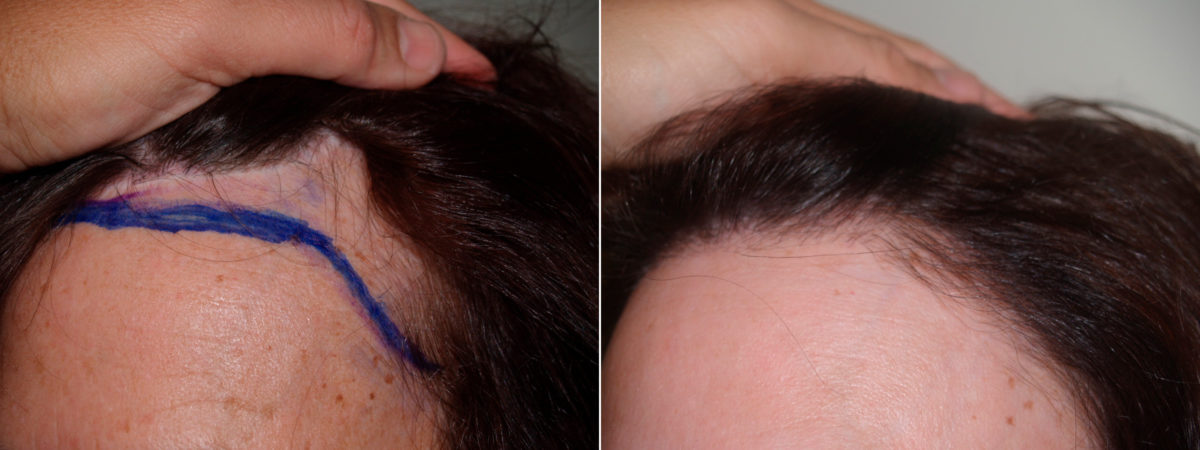Hair Transplants for Women Before and after in Miami, FL, Paciente 70923
