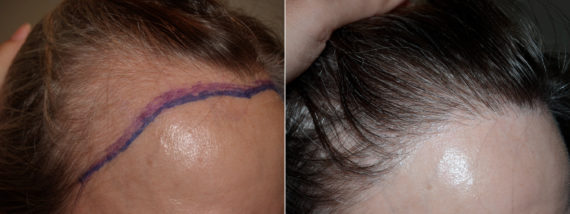 Hair Transplants for Women Before and after in Miami, FL, Paciente 70955