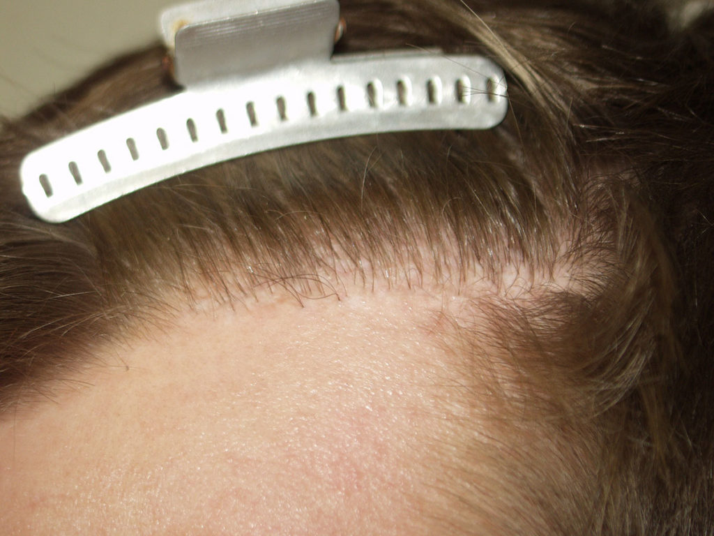 Otro ejemplo de escisión quirúrgica de la línea del cabello- en este caso, sólo una parte de la línea del cabello fue extirpada.
