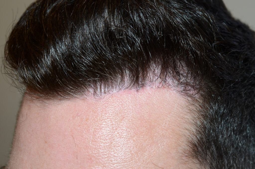 Tres meses después de la escisión parcial de la línea del cabello para reparar la cicatrización y la apariencia antinatural causada por el trasplante de cabello previo.