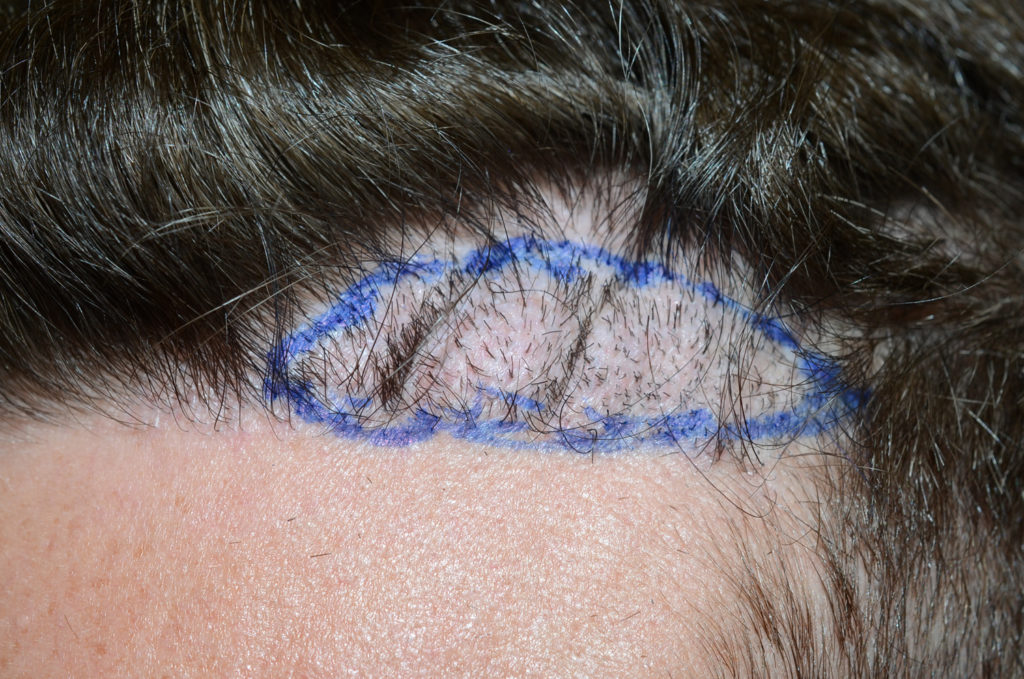 Antes de la escisión parcial de la línea del cabello para reparar la cicatrización y la apariencia antinatural causada por el trasplante de cabello previo.