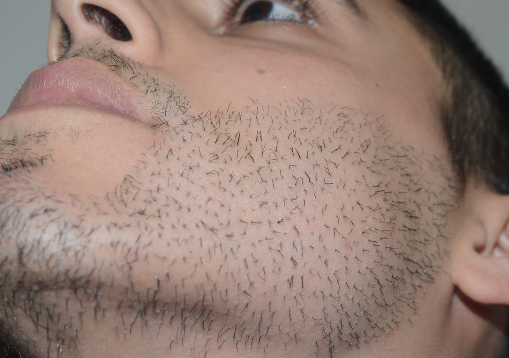 Antes, un día después, y cuatro meses después de la eliminación de FUE de más de 800 injertos de barba que se implantaron en un ángulo inadecuado y contenían tres o más pelos. ANTES