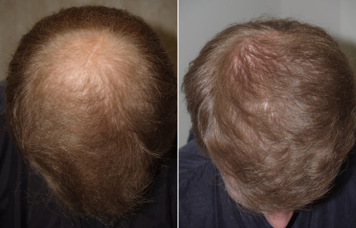 Hair Transplants for Men Before and after in Miami, FL, Paciente 94590