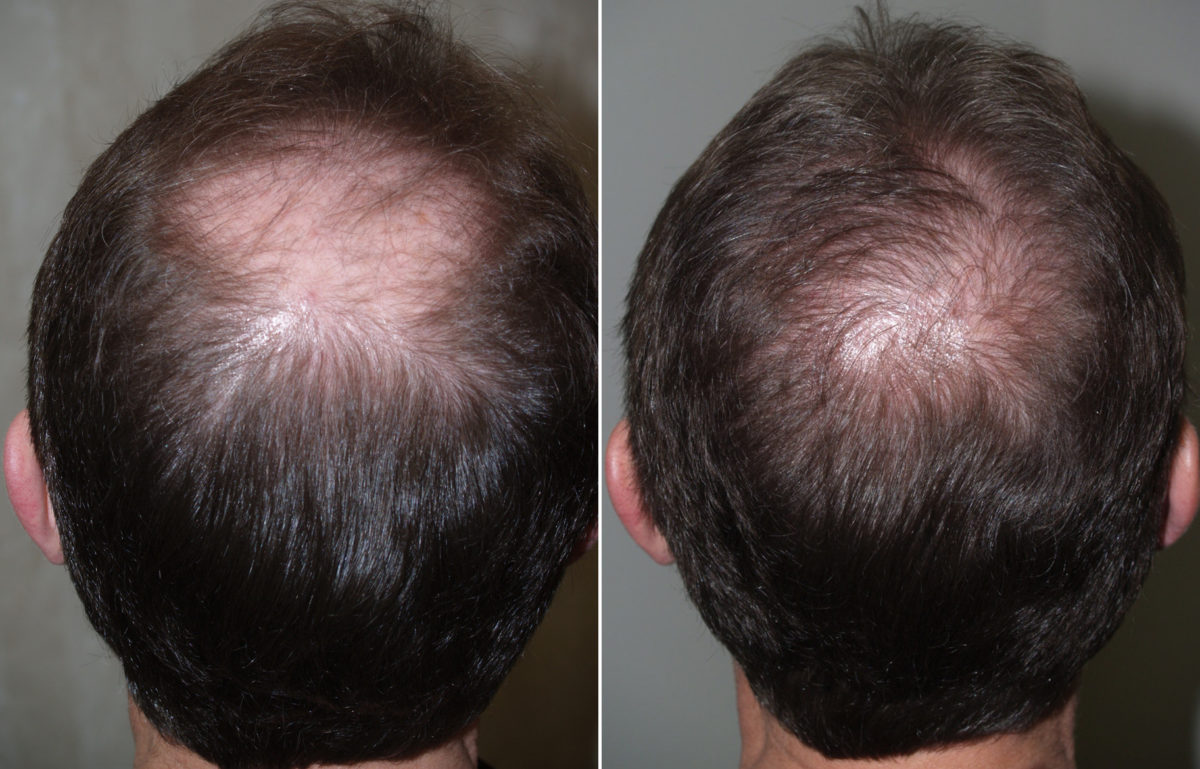 Hair Transplants for Men Before and after in Miami, FL, Paciente 94604