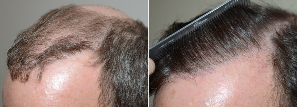 Antes y un año después de 1700 injertos para reparar una línea de pelo que aparece antinatural
