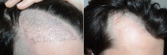 Reparative Hair Transplant Before and after in Miami, FL, Paciente 98687